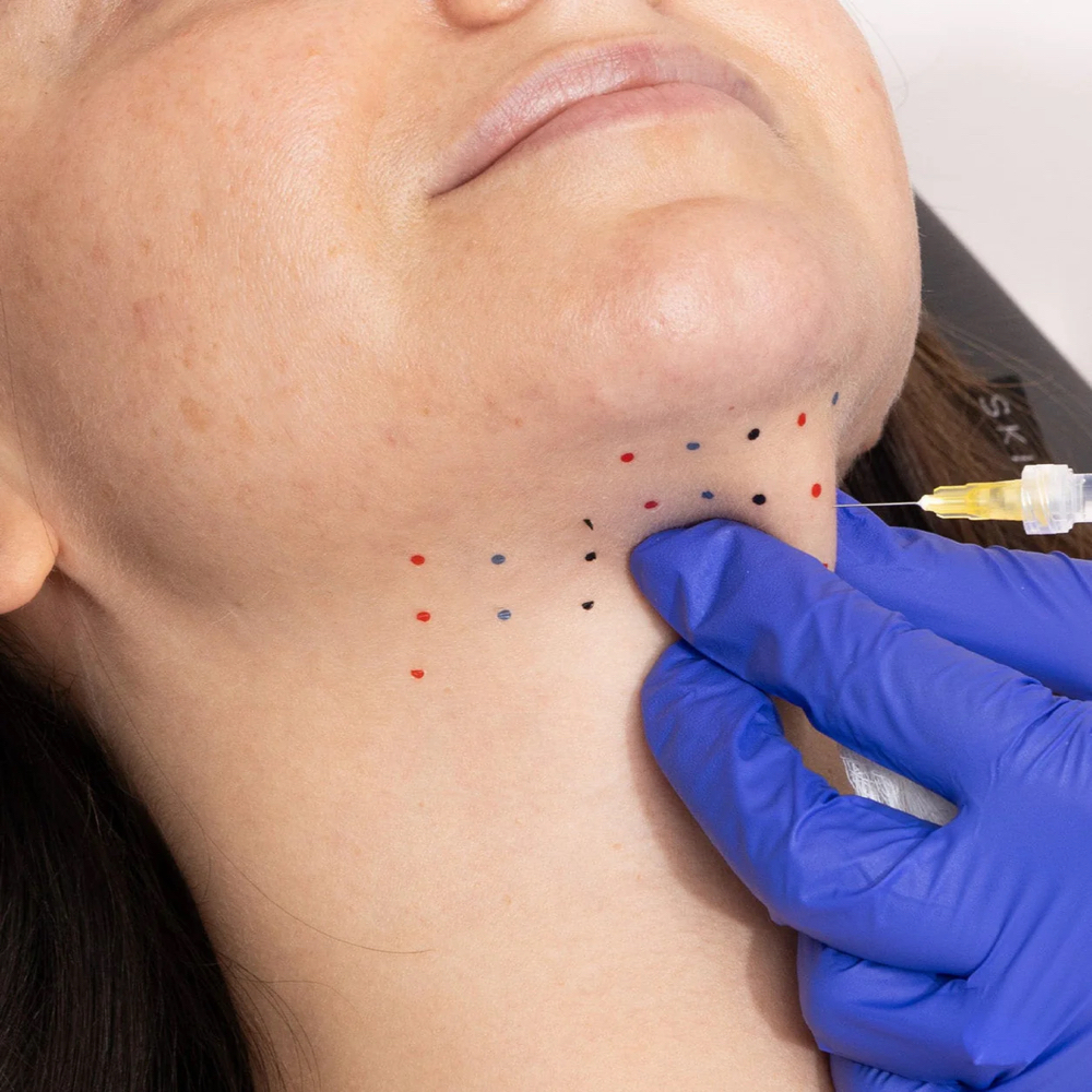Kybella at The Beauty ER in Webster, MA