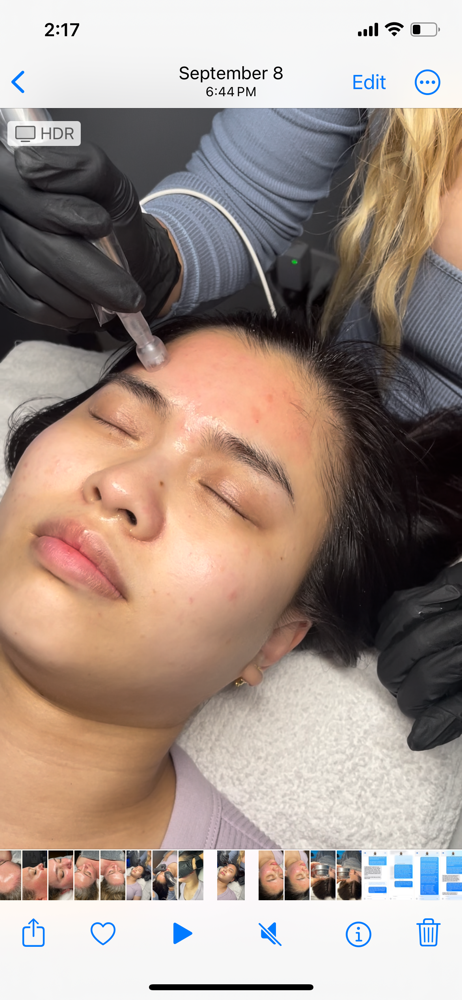 Microneedling (FACE)