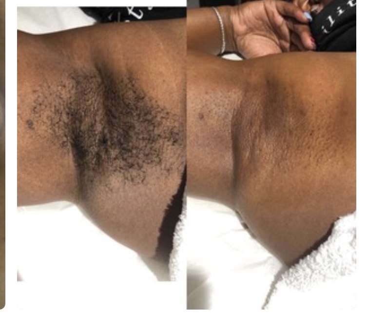 Underarm Wax