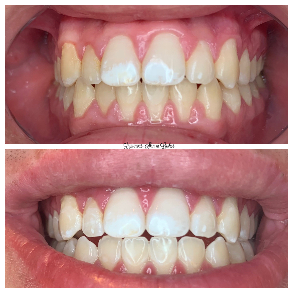 Teeth Whitening- 90 Min