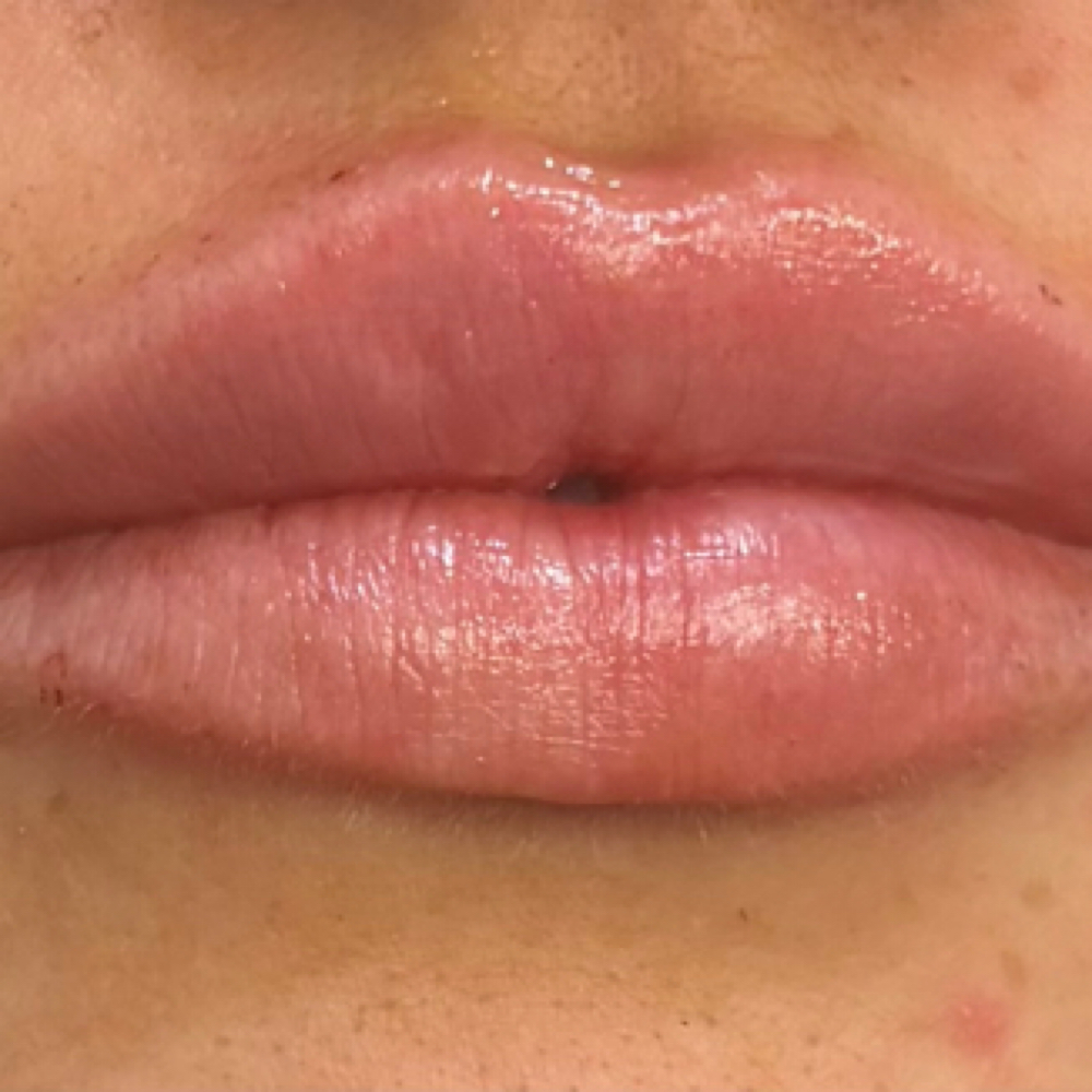 Filler at Alexandria Paige Aesthetics in Wentzville, MO