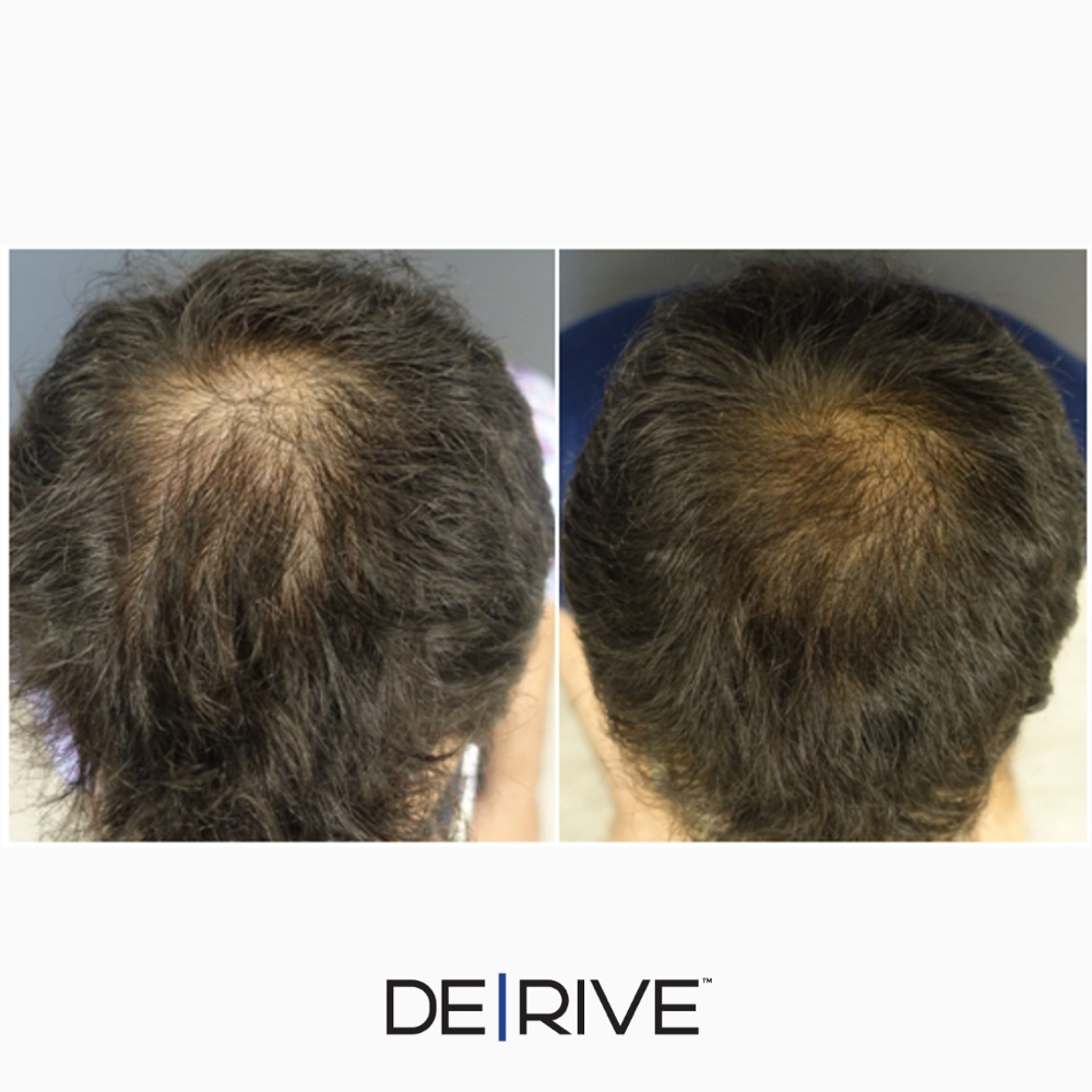 Add On DE|RIVE Hair Support