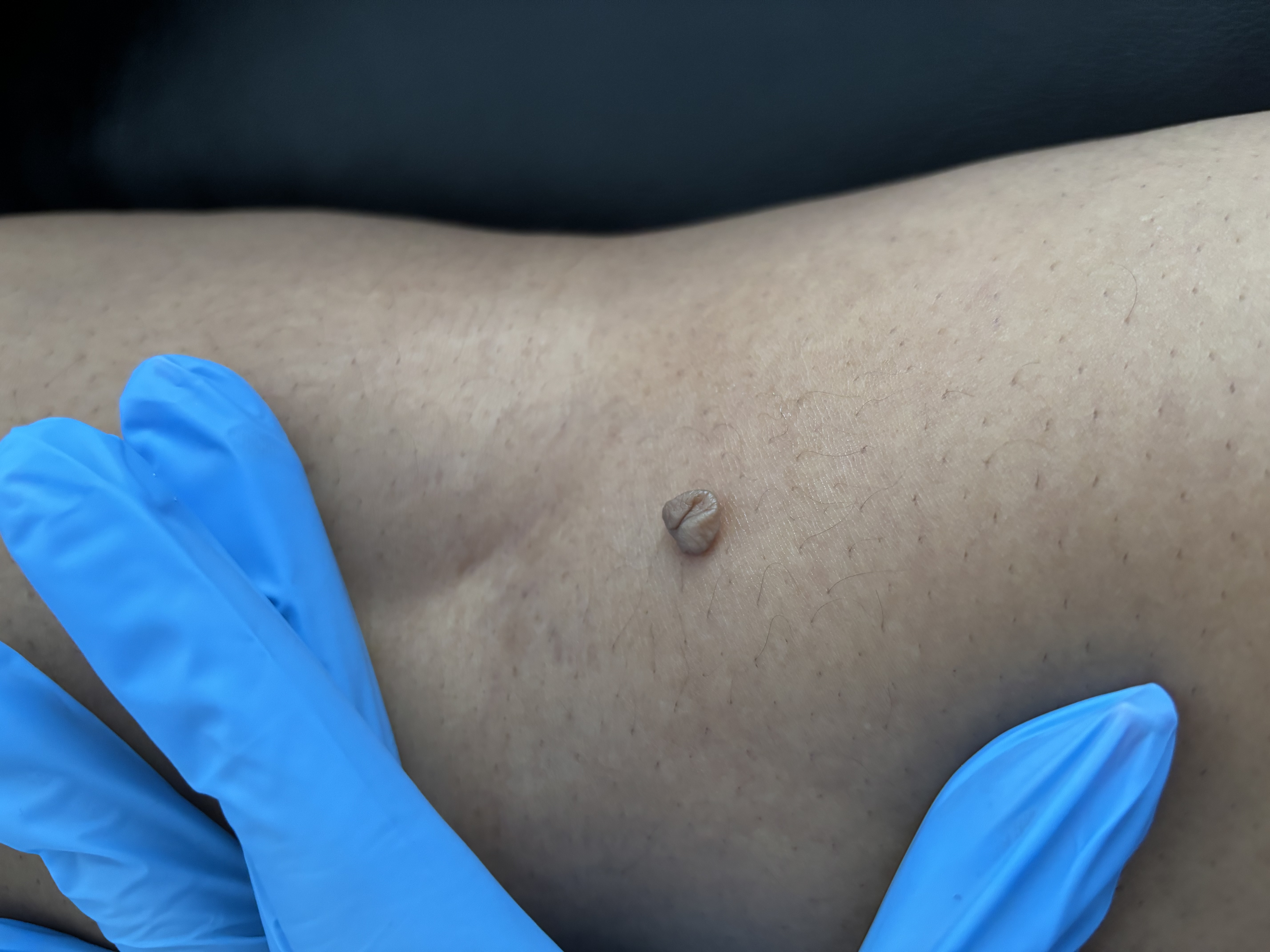 SKIN TAG/DPN REMOVAL - CONSULT REQ