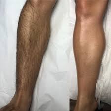 Male Upper or Lower Leg