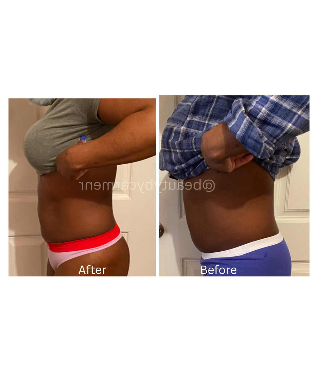 Hour Glass-Belly, Cellulite, Butt 3