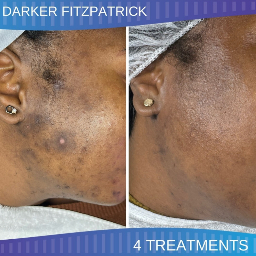 Microchanneling Treatment at Detroit Skintique in Troy, MI