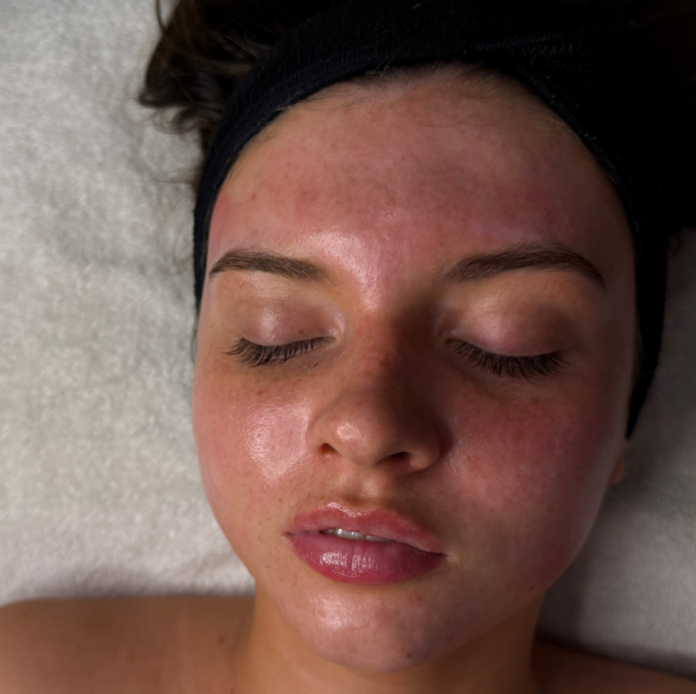 Non-Surgical Face Lift at Esthetics By Emma in Church Hill, TN