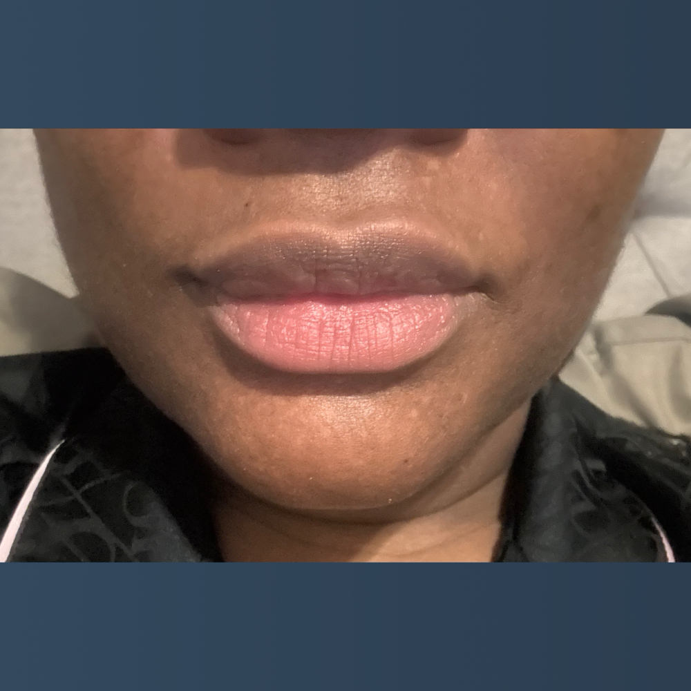 Lip Dermal Fillers