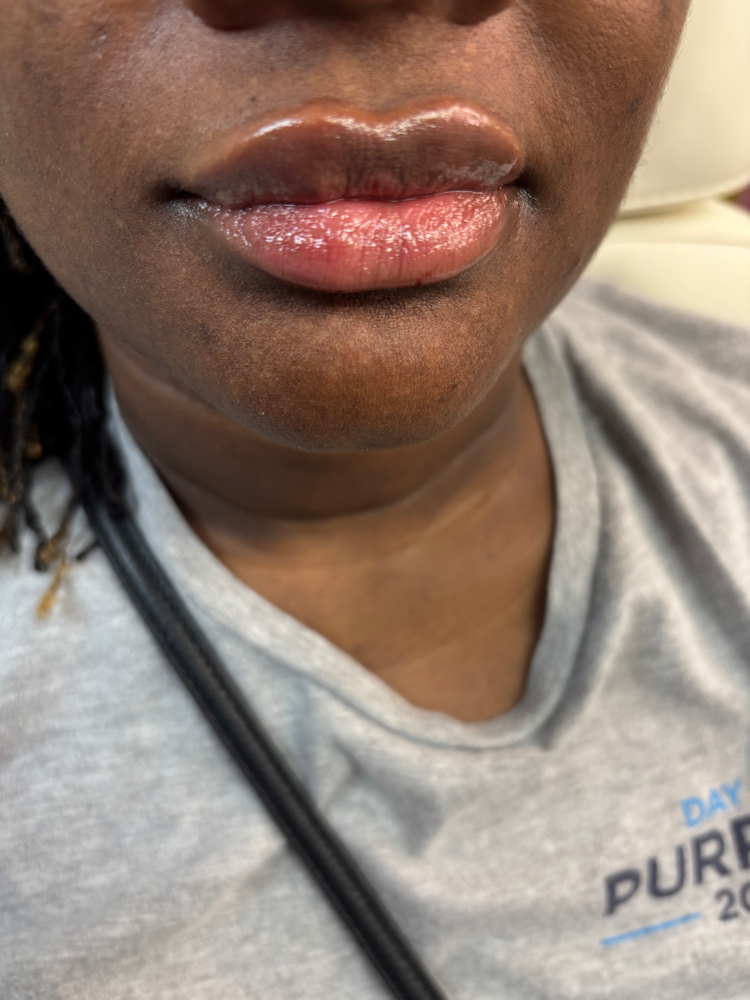 Dermal Fillers