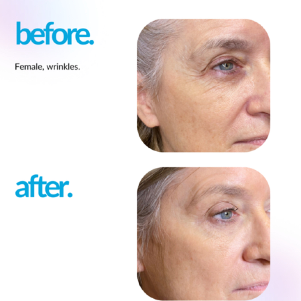 Full Face Microchanneling at Altar Beauty Co. by Yury in Payette, ID