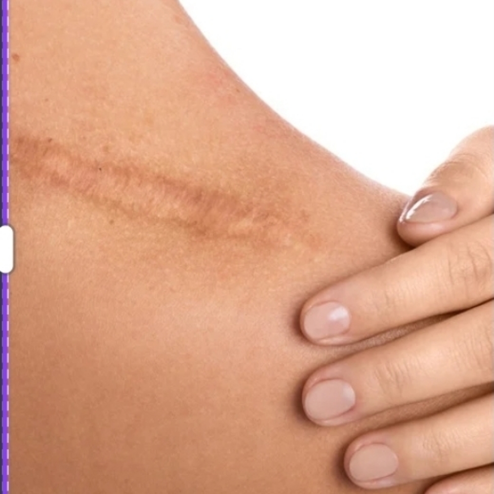 SCAR CAMOUFLAGE (Medium Size)