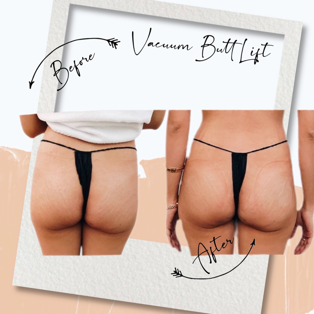 Vacuum Butt Lift