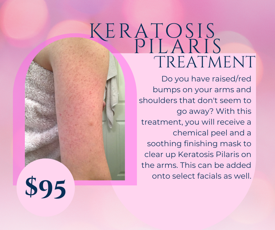 Keratosis Pilaris Treatment