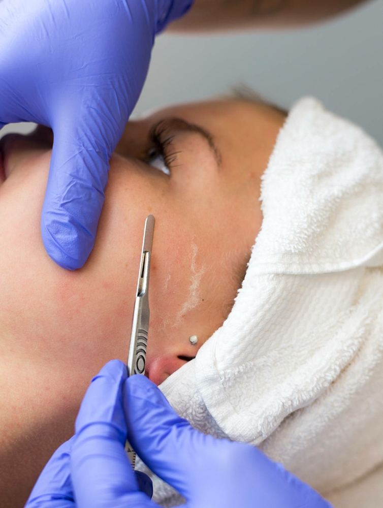 Dermaplane +Vitamin Infusion Facial