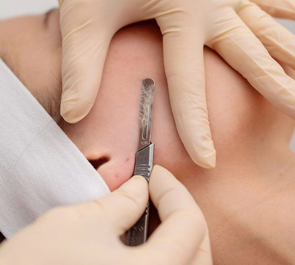 Dermaplaning Facial