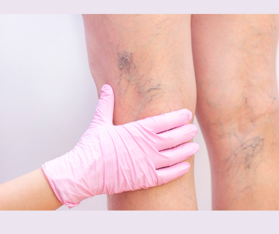 Spider Vein Laser Treatment
