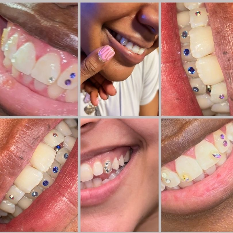 Teeth whitening & Tooth Gems