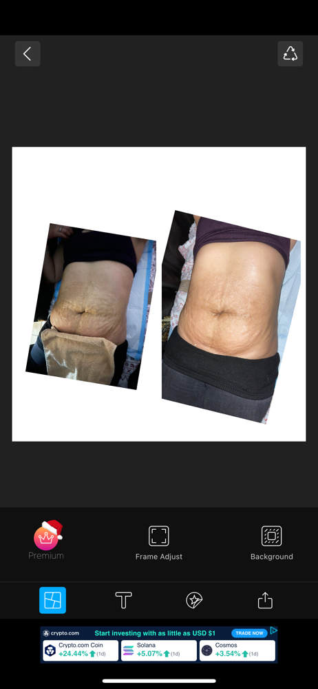 Skin Tightening