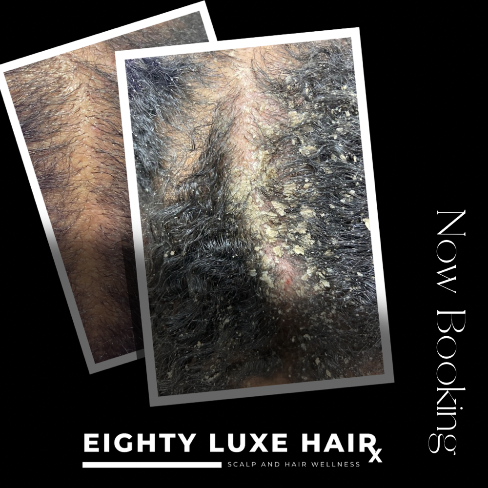 Scalp Therapy Package