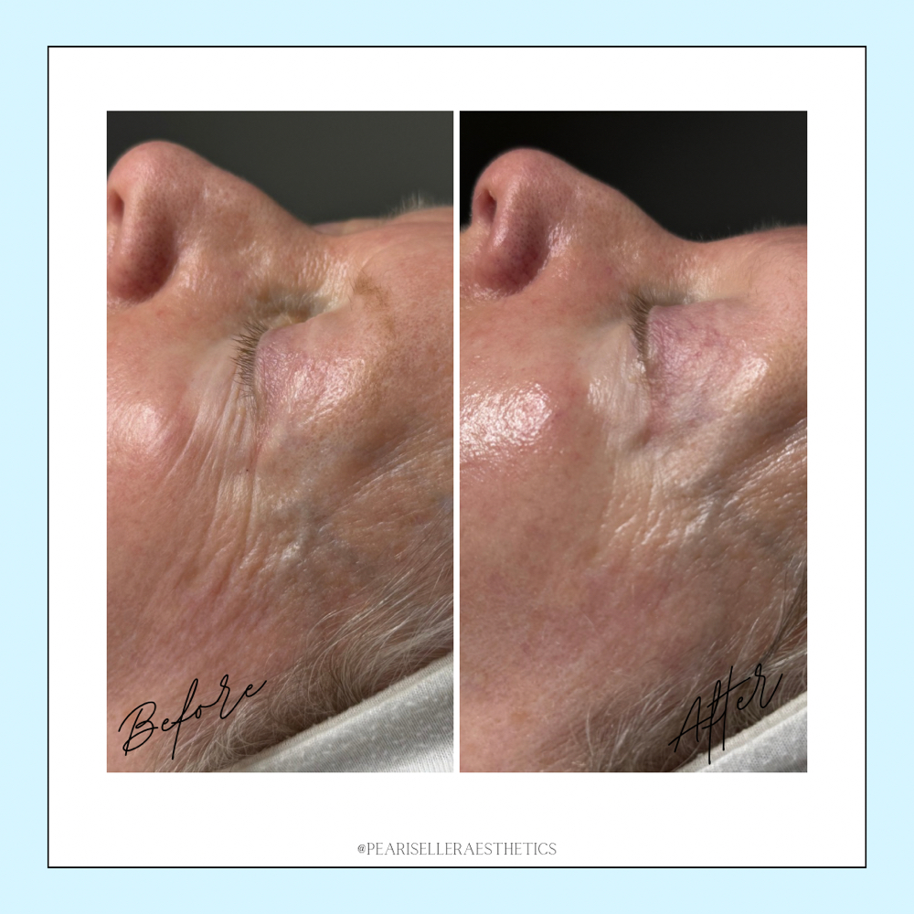 Botox In A Bottle Facial at Pearis Eller Aesthetics in Port Wentworth, GA