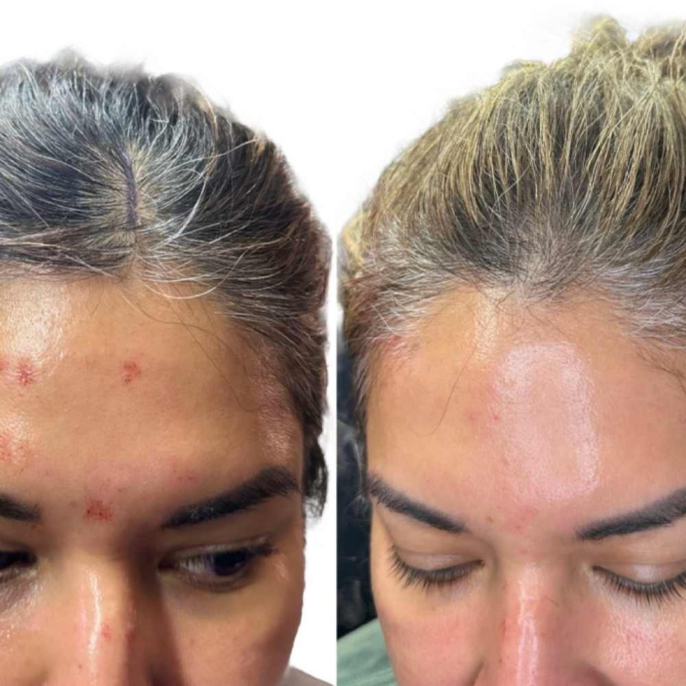 PRP Hair Restoration at BlackBird Aesthetics in Fort Worth, TX