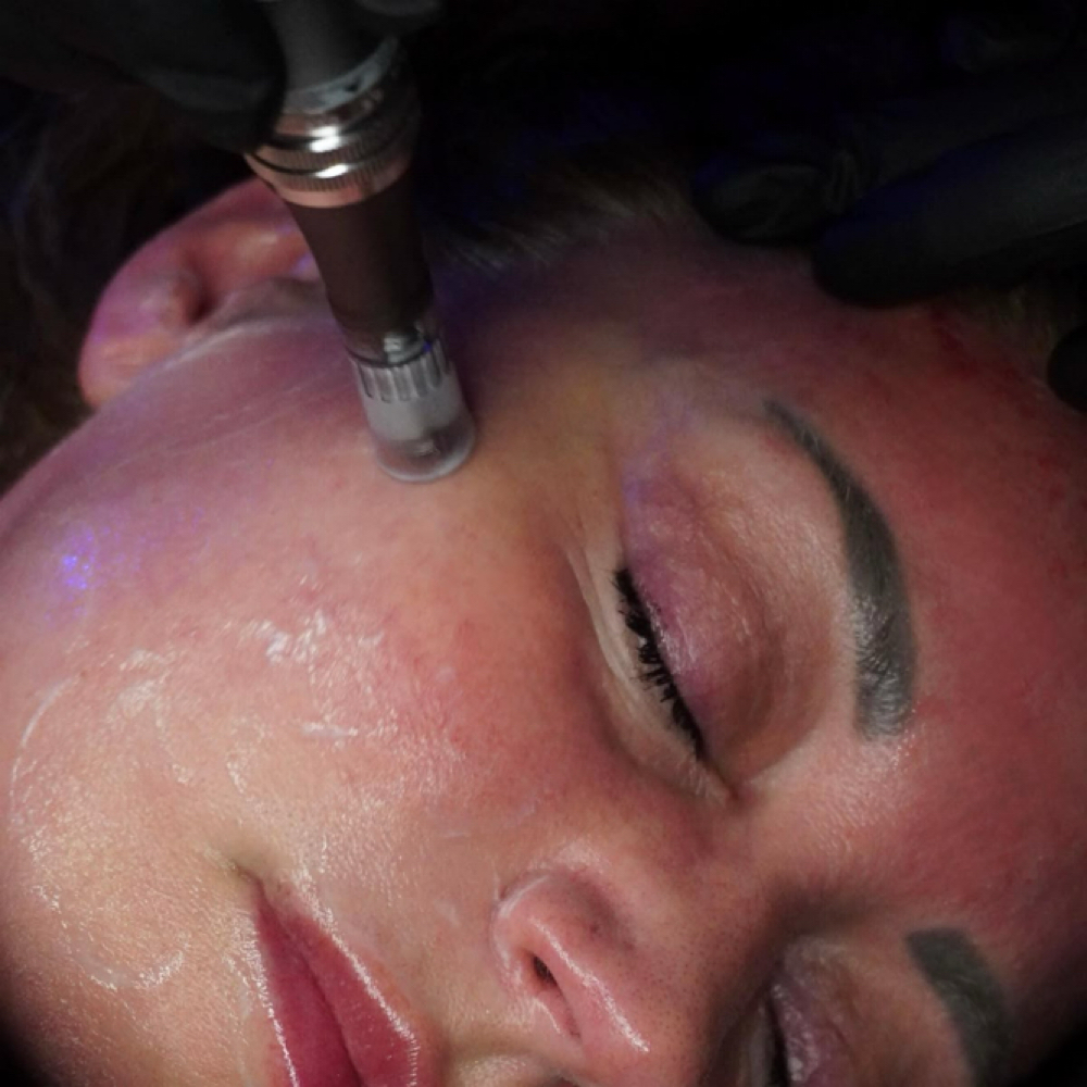 Basic Nanoinfusion Treatment at Haylee Jade Esthetics LLC in Ellijay, GA