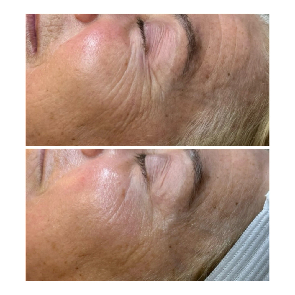 Basic Nanoinfusion Treatment at Haylee Jade Esthetics LLC in Ellijay, GA