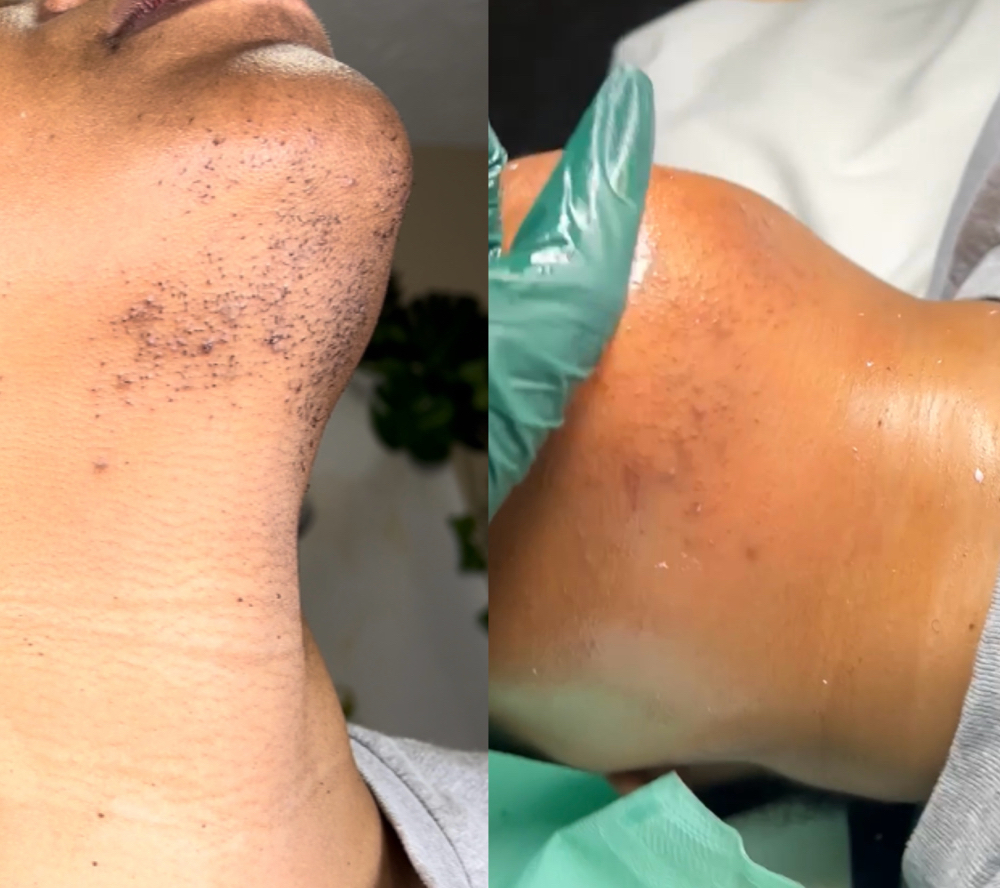 Chin Wax at ๐ข๐ฑ๐ฎ๐๐ต๐ฒ๐ท๐๐ in Charlotte, NC