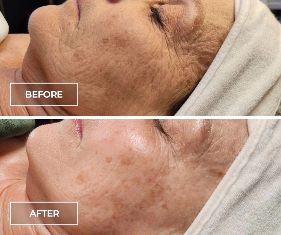 The SWiCH™ Treatment by Circadia