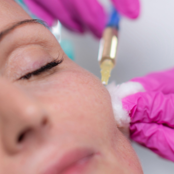 Hyaluronic acid fillers at Beleza Medspa in Denton, TX