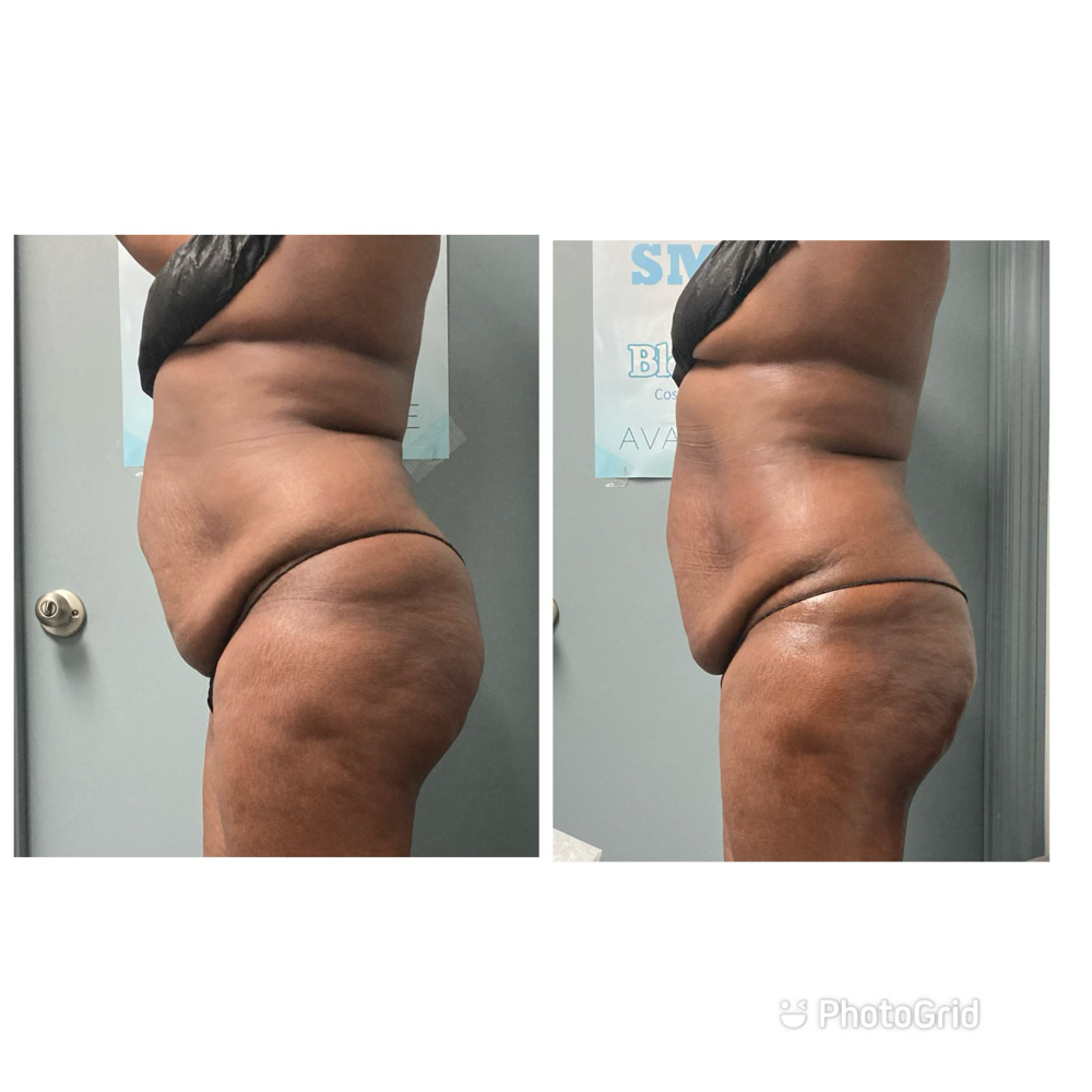 1 Cavitation & Laser Lipo Session