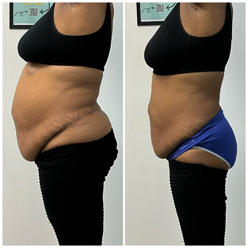 Cavitation & Laser Lipo Session