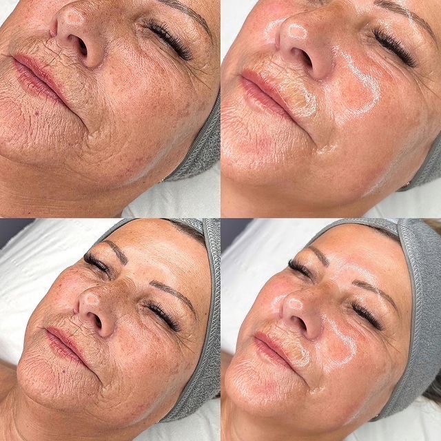 Firming Peptide Wrinkle Reduction