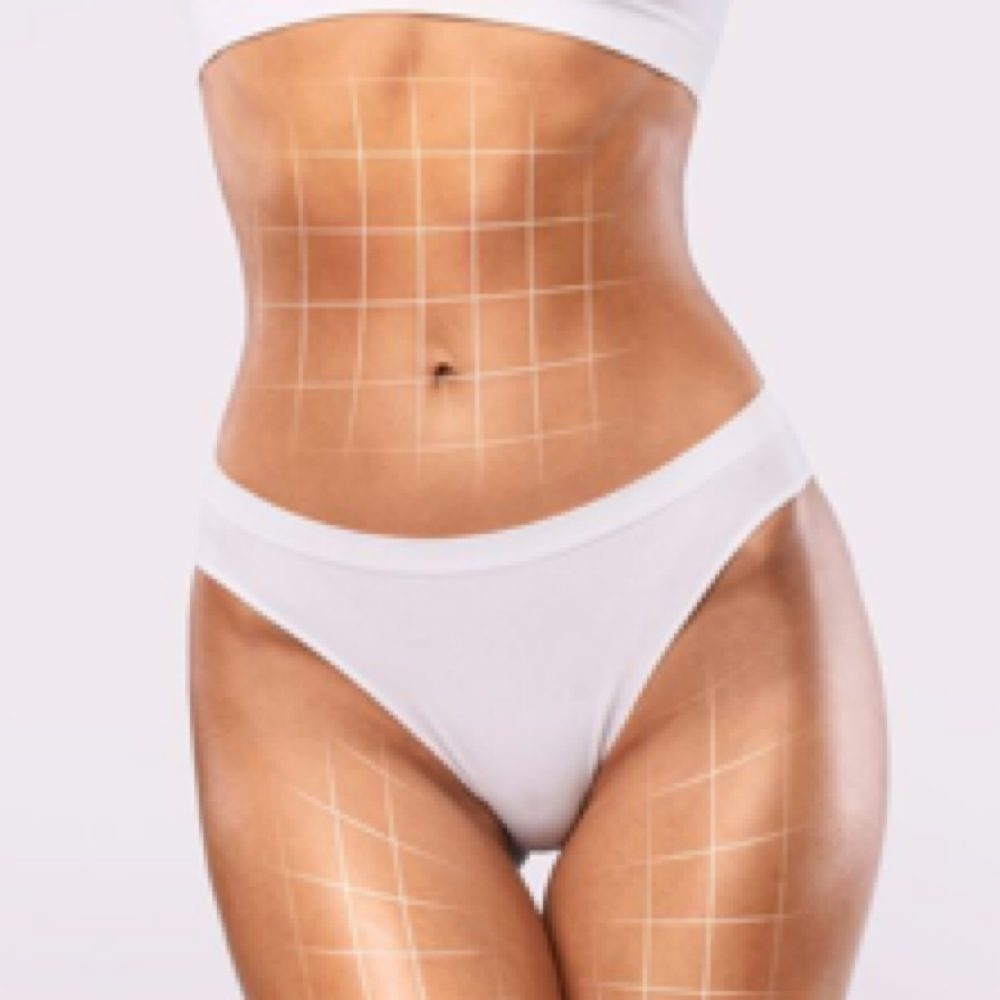 Fat reduction Meso-Quemadores at LM BEAUTY AESTHETICS in Everett, MA