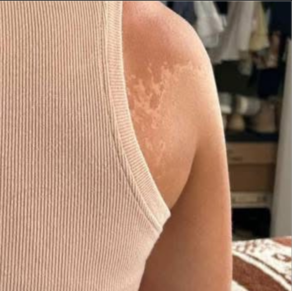 Glow Fix: Sunburn Color Correction