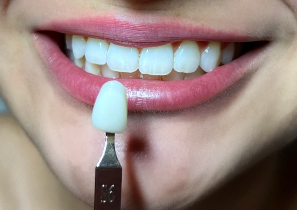 Teeth Whitening 60 Min Session