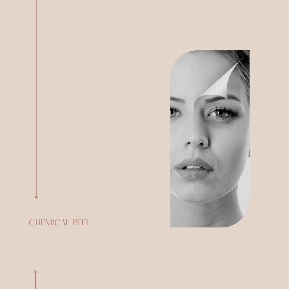 Chemical Peel