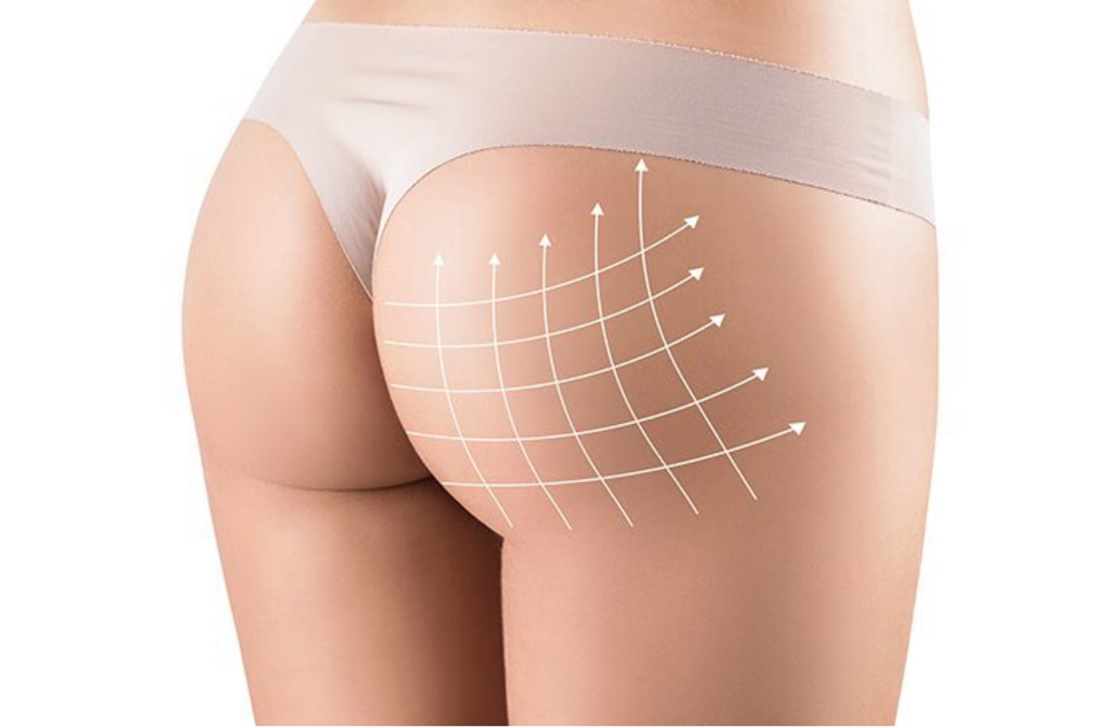 Buttocks Filler Sculptra 10 Vials
