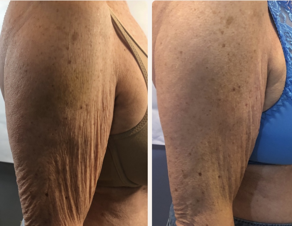 Cryoskin Toning
