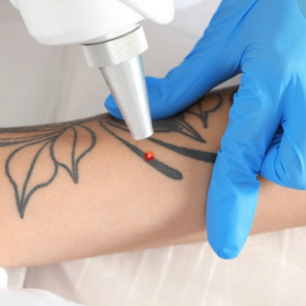 Tattoo Removal at Luvlookbeautyspa @GlossGenius in Las Vegas, NV