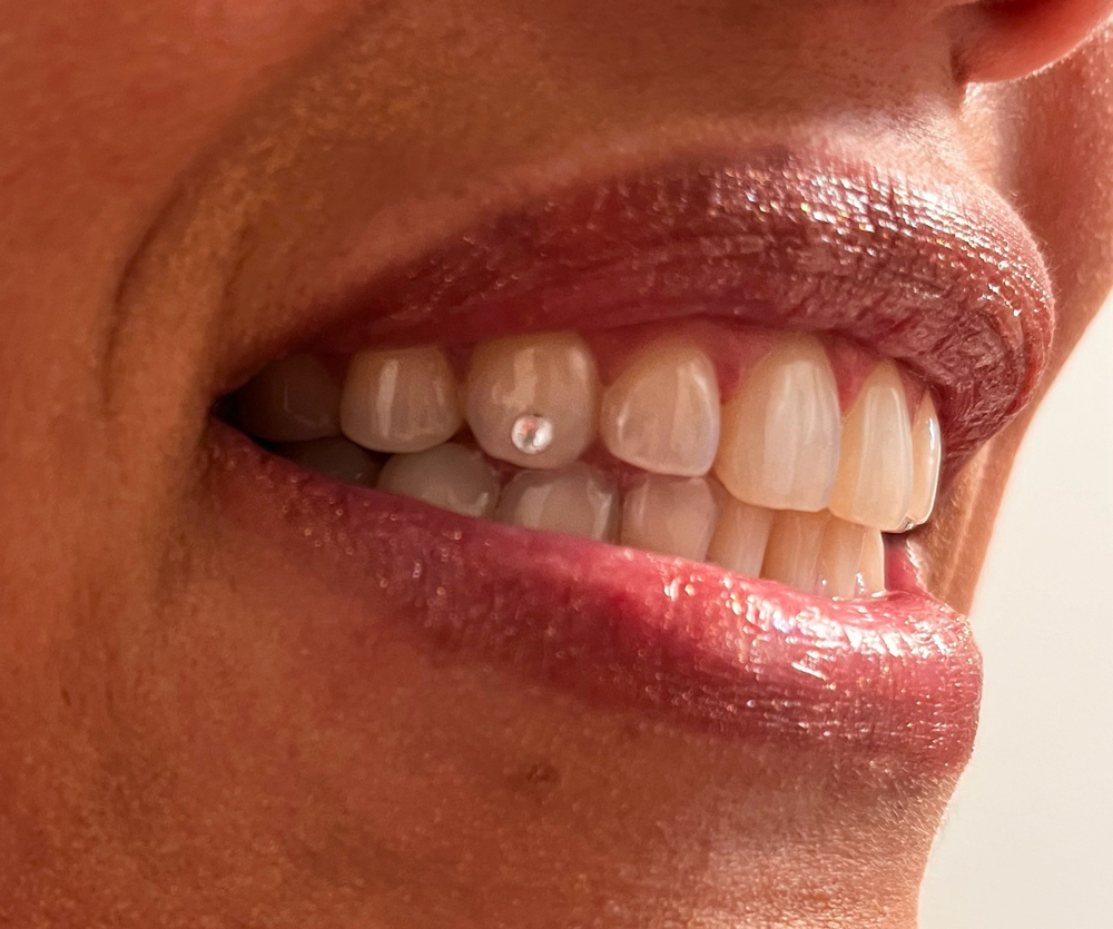 Tooth Gems