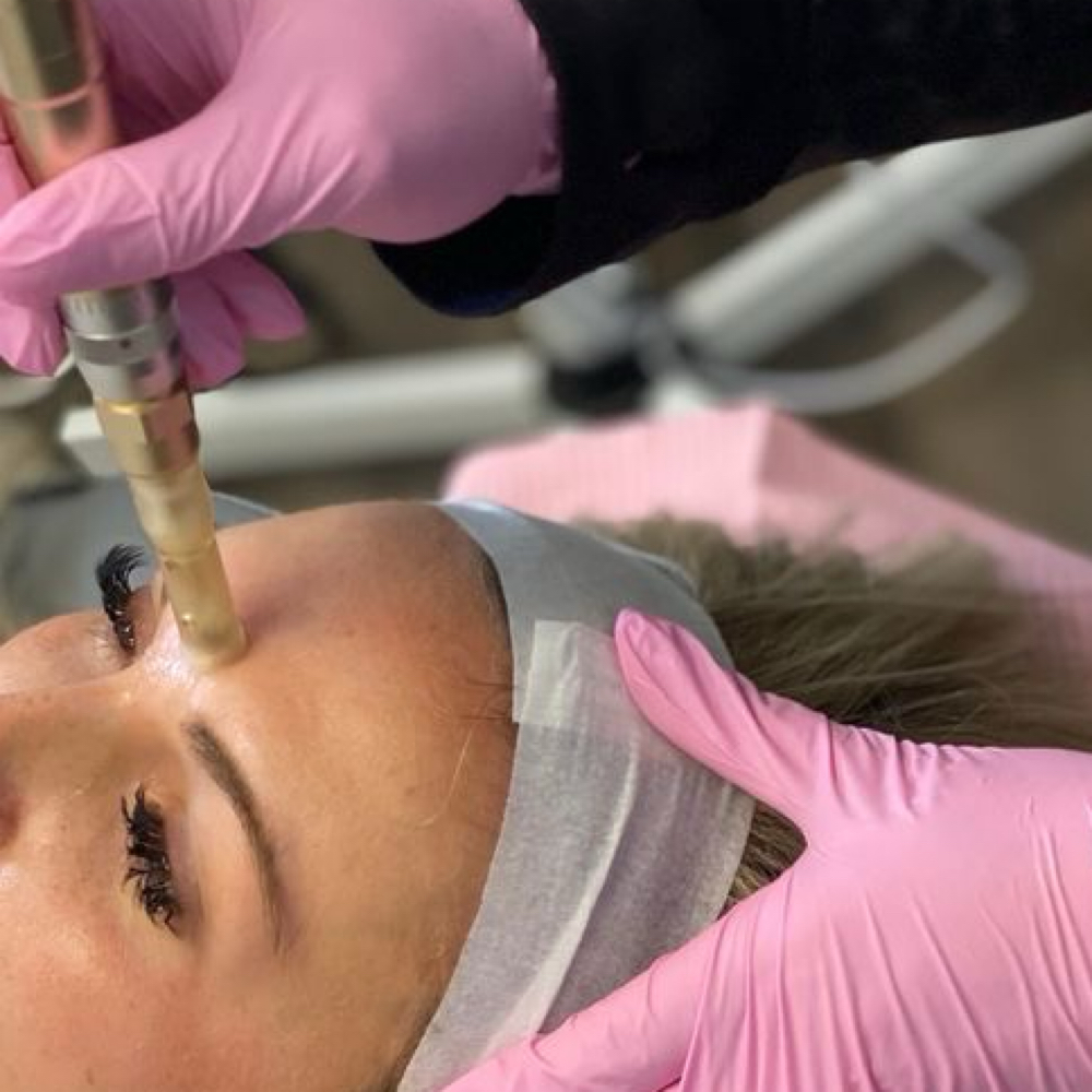 Microneedling with PRP at Sharon Nicole Aesthetics in Patchogue, NY