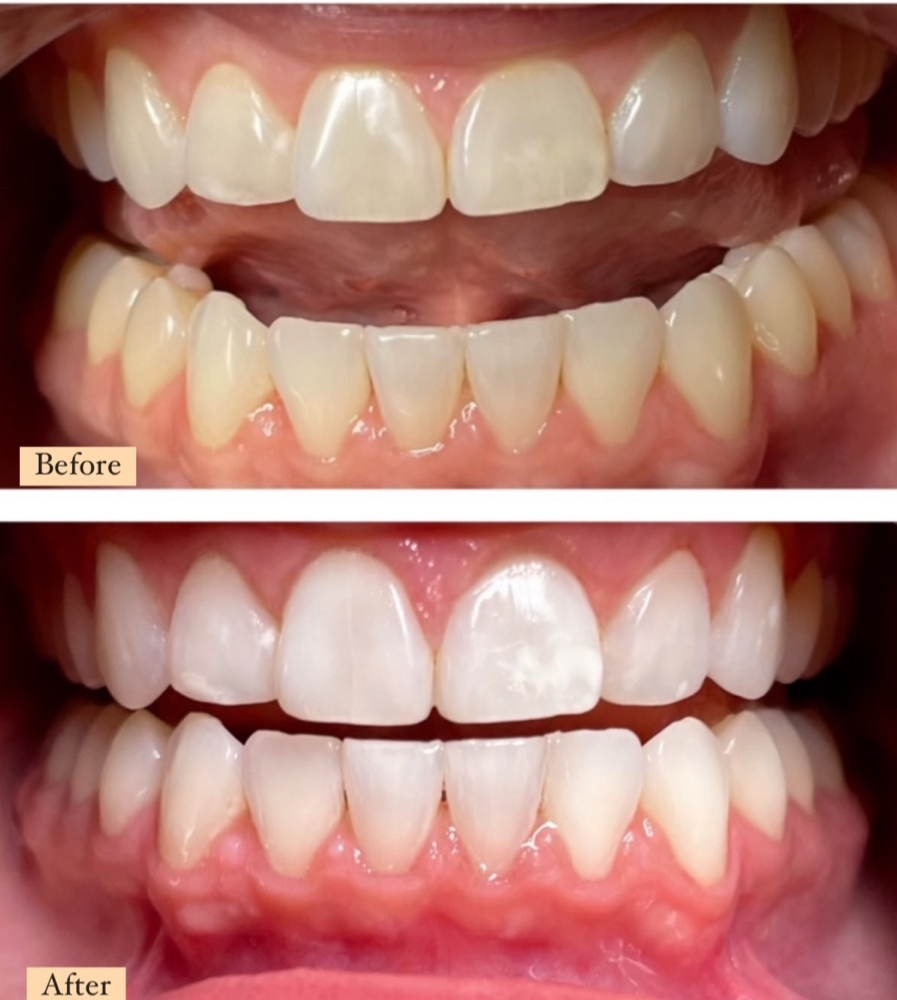 90 MINS TEETH WHITENING