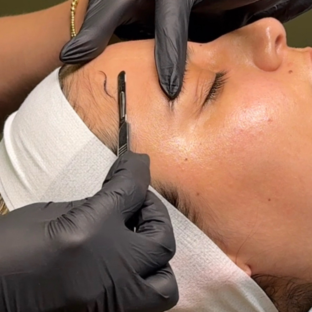 Dermaplaning at Nurse Lab Aesthetics & Wellness in Mission, TX