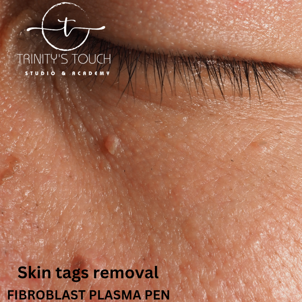 SKIN TAGS REMOVAL