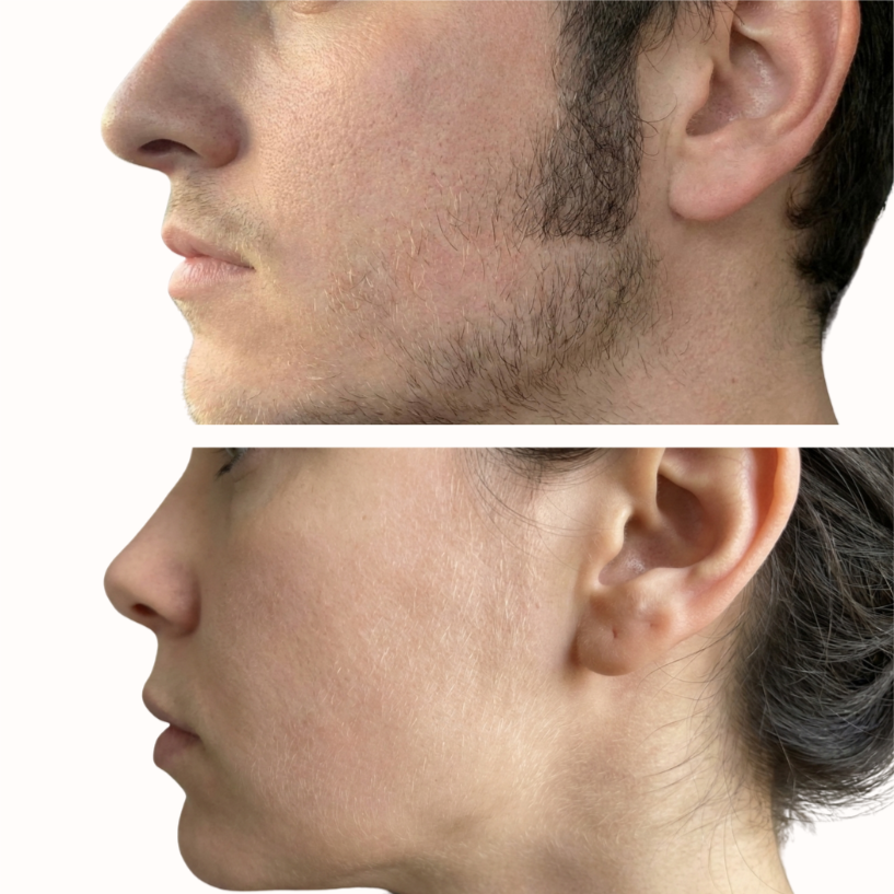 Sideburn at Bareline Aesthetics in Brea, CA