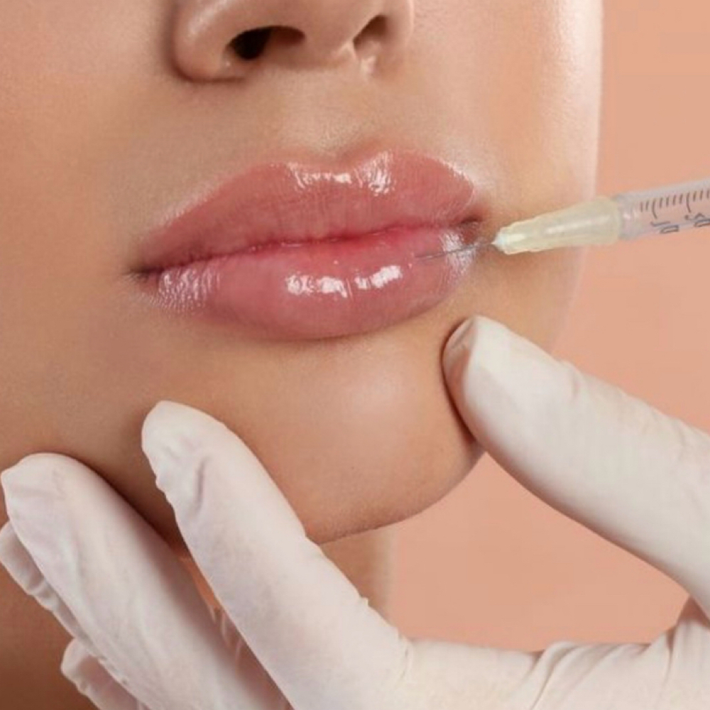 Dermal Filler (1ml ) + Consultation at Adrienne Hopeโs Aesthetics in Denver, CO