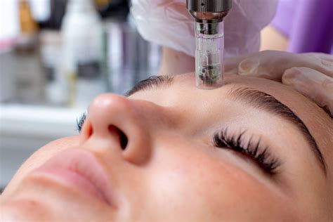 Micro-Needling + Chemical Peel