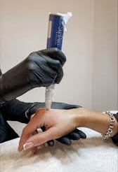 Special:Hand Microneedling+StemCell