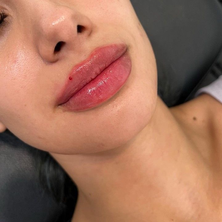 Lip Filler